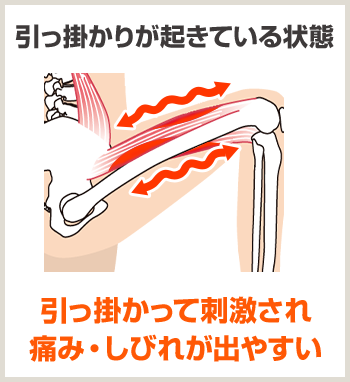 引っ掛かりが起きている状態